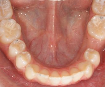 Lückenschluss bei Nichtanlage Zahn 35